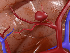 Abdominal Aortic Aneurysm