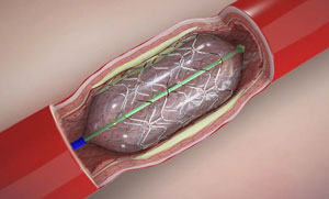angioplasty-and-stents