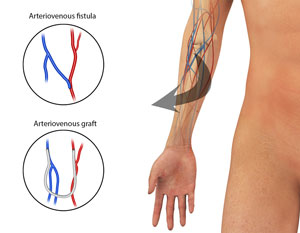 arteriovenous-fistual-creation-for-dialysis-access