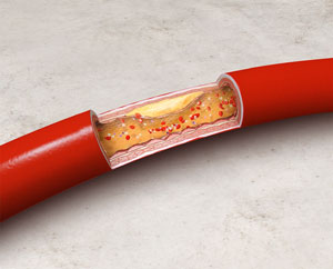 atherosclerosis