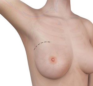 breast-surgery