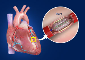 coronary-angioplasty