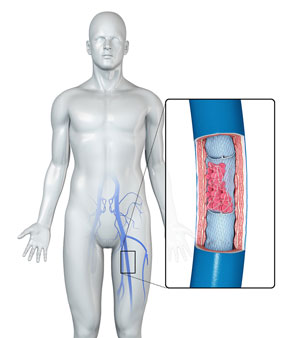 Deep Vein Thrombosis Treatment Chino CA