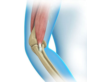 Elbow Tendon and Ligament Repair