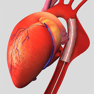 endovascular-aneurysm-repair