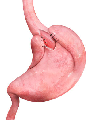 heller-myotomy
