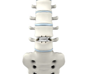 Lumbar Disc Replacement