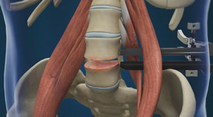 lumbar-discectomy