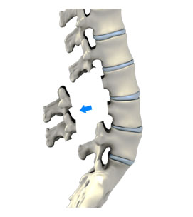 lumbar-laminectomy