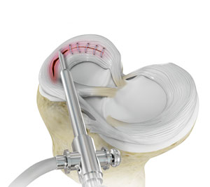 Interventional Radiology