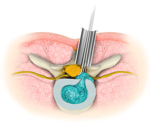 Minimally Invasive Spine Surgery