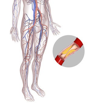 peripheral-arterial-disease