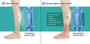 Varicose Veins