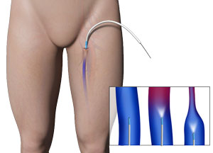 venous-ablation